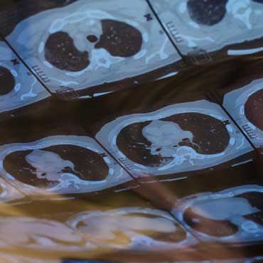 CT scans